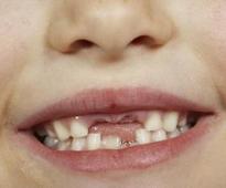 Scientists Finding Way to Evoke Process of Teeth Re-growth in Humans