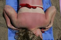 Had Too Much Sun?