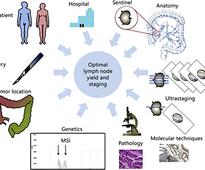 Qualitative and Quantitative Issues of Lymph Nodes as Prognostic Factor in Colon Cancer