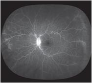 Acute RVO: What's Your Protocol?