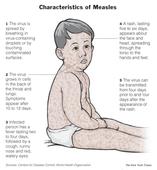 Measles claims 3 more minors