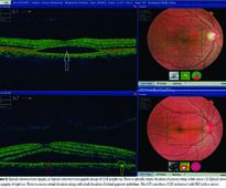 Features of central serous chorioretinopathy presenting at a tertiary care hospital in Lahore