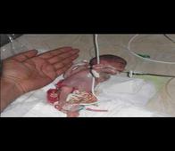 26-week, 468-gram baby becomes the lightest newborn in India; brings malnutrition in Gujarat under scanner