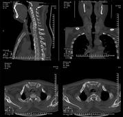 Tracheal Adenocarcinoma Treated with Adjuvant Radiation: A Case Report and Literature Review