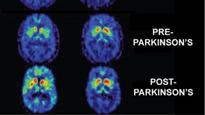 Diabetes drug moves Parkinson's treatment a step closer
