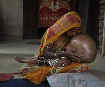 Indian medics conduct 'perfect' op on baby's swollen head